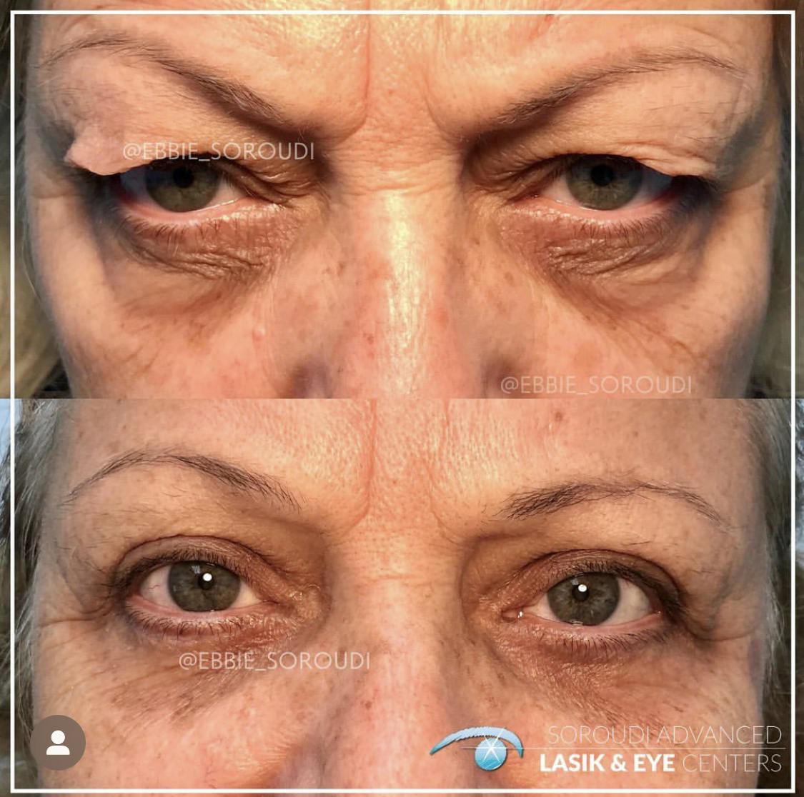 Blepharoplasty (Eyelid Surgery) Before & After Gallery - Patient 55495884 - Image 1