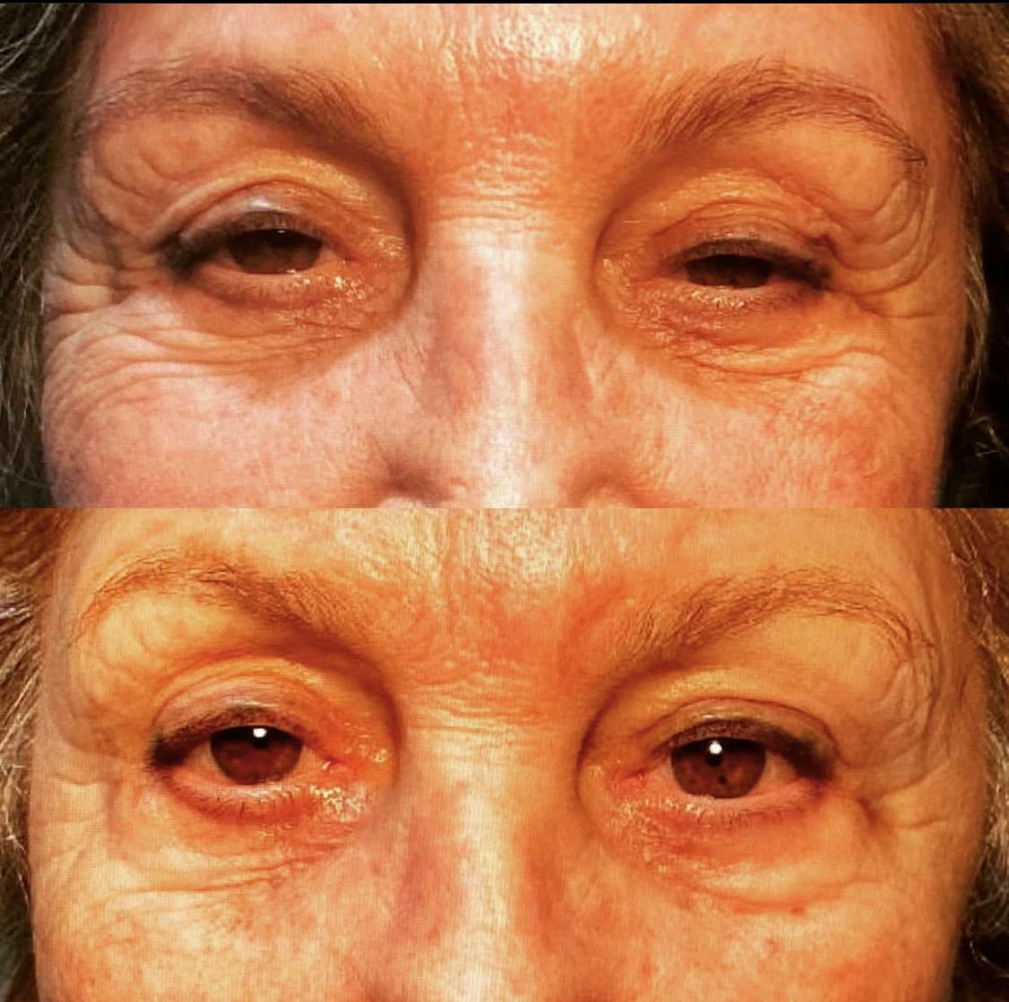 Droopy Eyelid Lift (