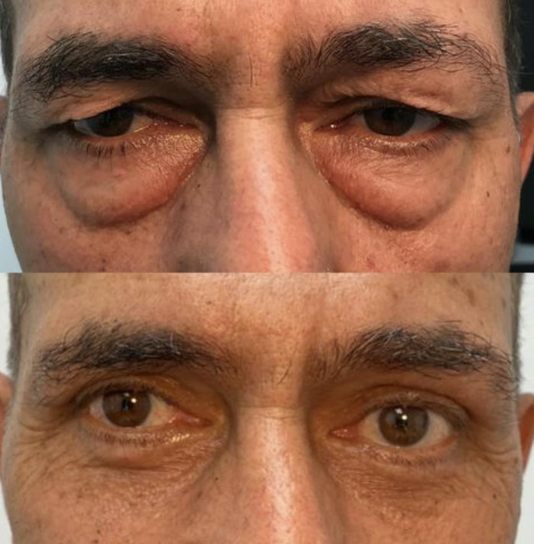 Blepharoplasty (Eyelid Surgery) Before & After Gallery - Patient 55495885 - Image 1