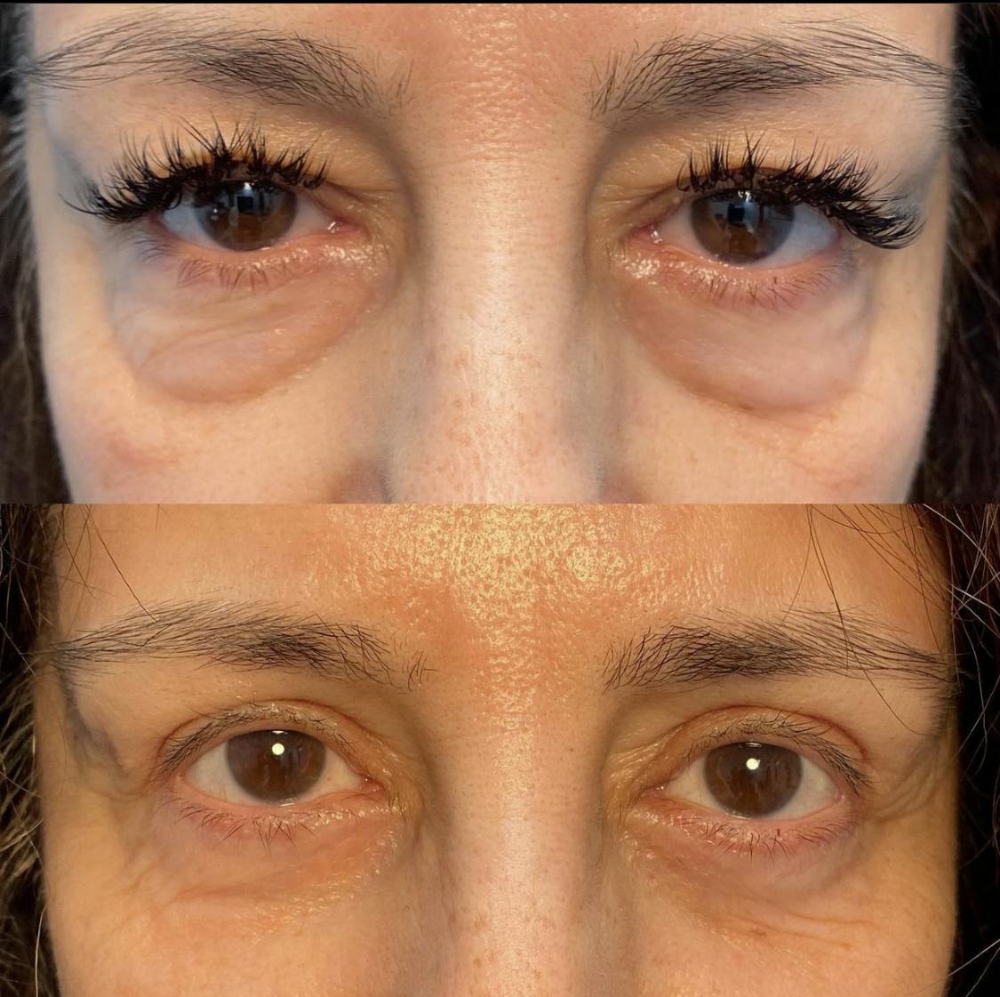 Blepharoplasty (Eyelid Surgery) Before & After Gallery - Patient 55495886 - Image 1