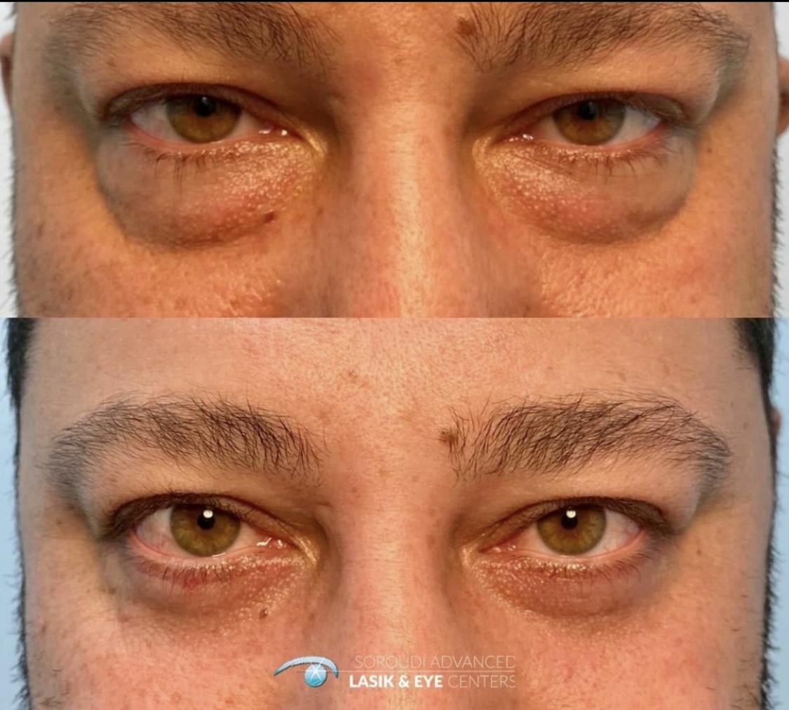 Blepharoplasty (Eyelid Surgery) Before & After Gallery - Patient 55495861 - Image 1