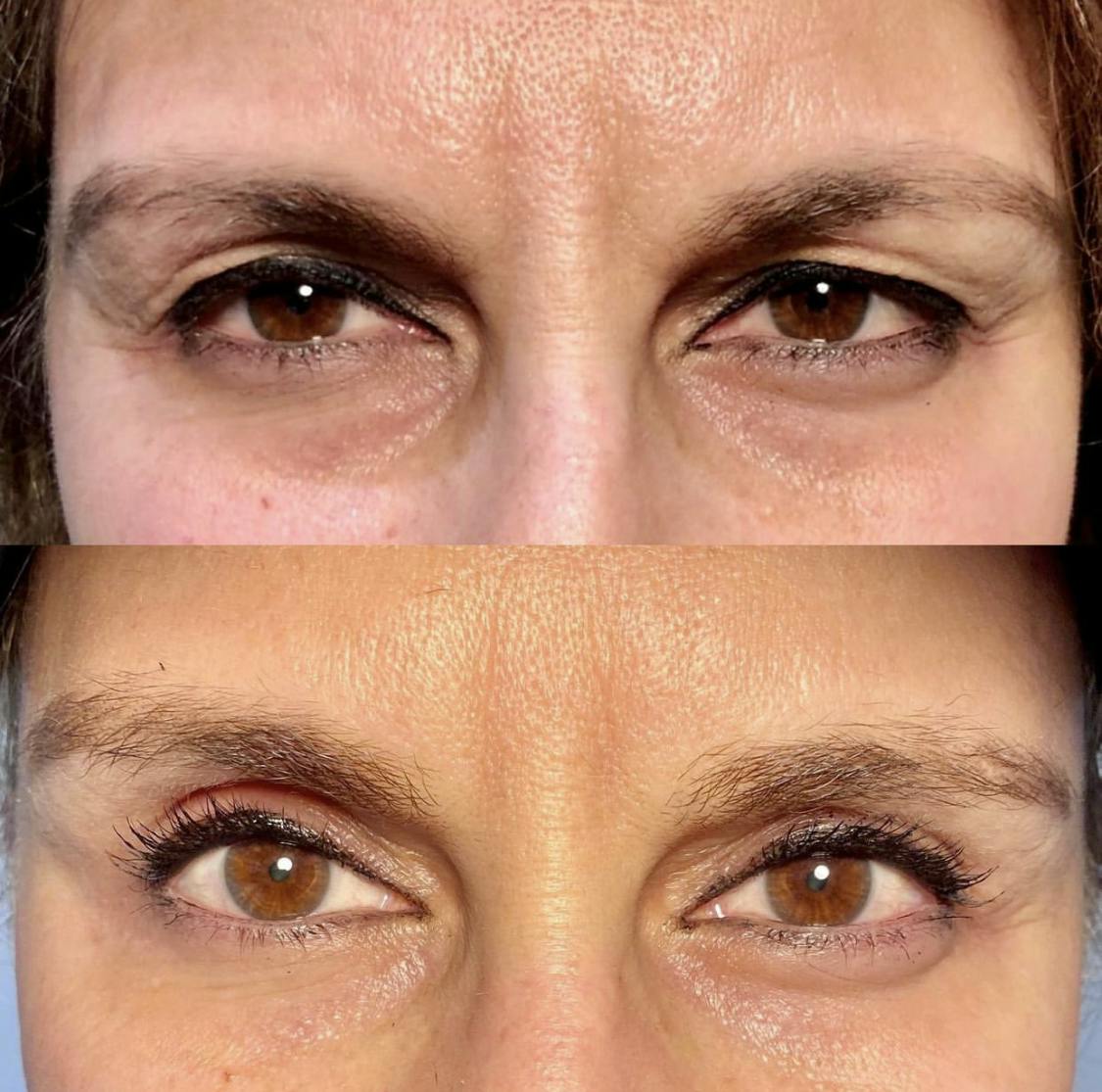 Blepharoplasty (Eyelid Surgery) Before & After Gallery - Patient 55495887 - Image 1