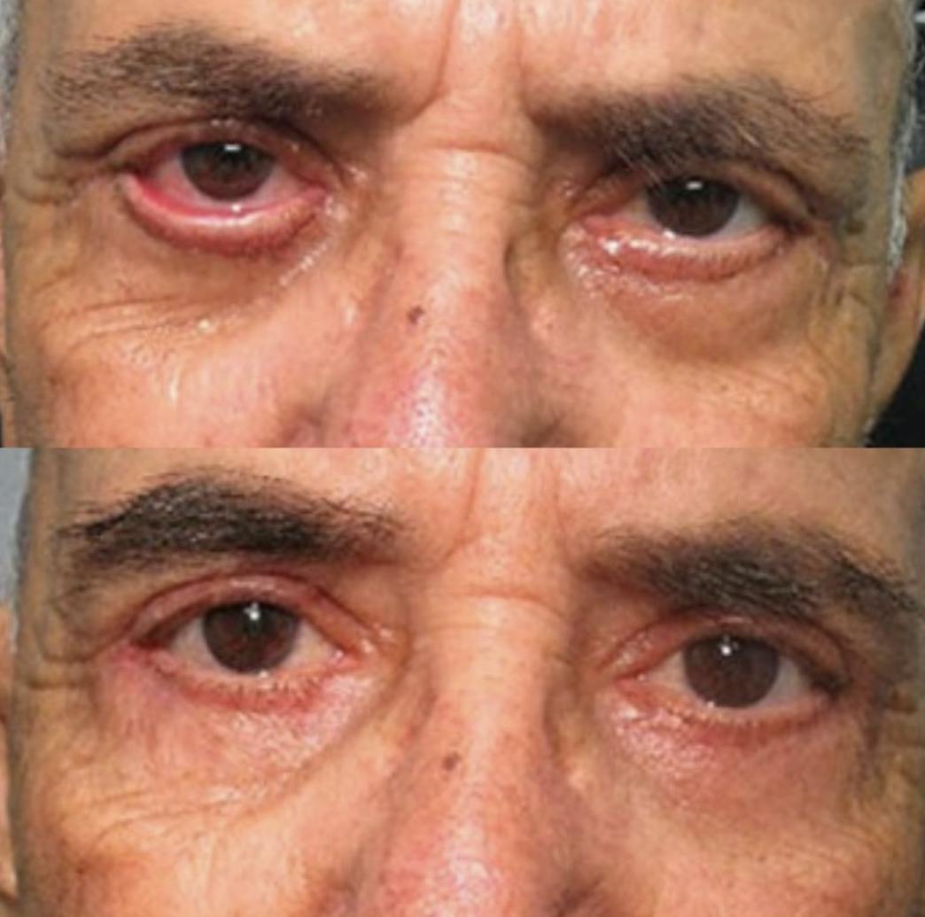 Ectropion (Everted Eyelid) Correction Before & After Gallery - Patient 53704677 - Image 1