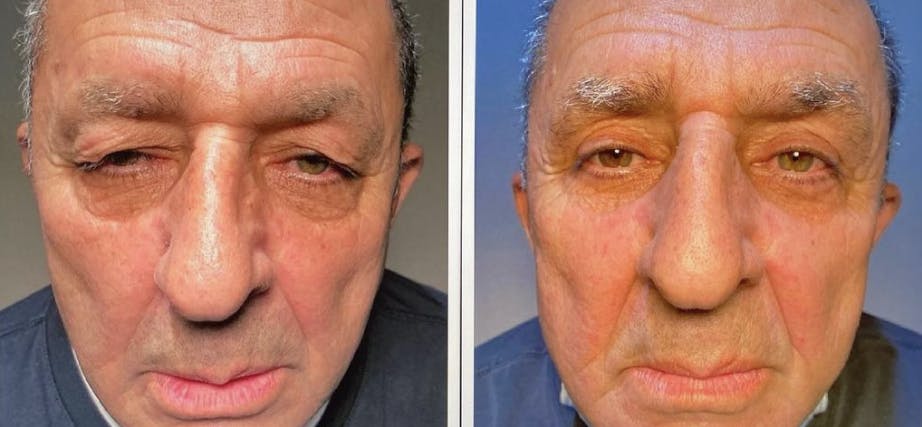Blepharoplasty (Eyelid Surgery) Before & After Gallery - Patient 55495888 - Image 1