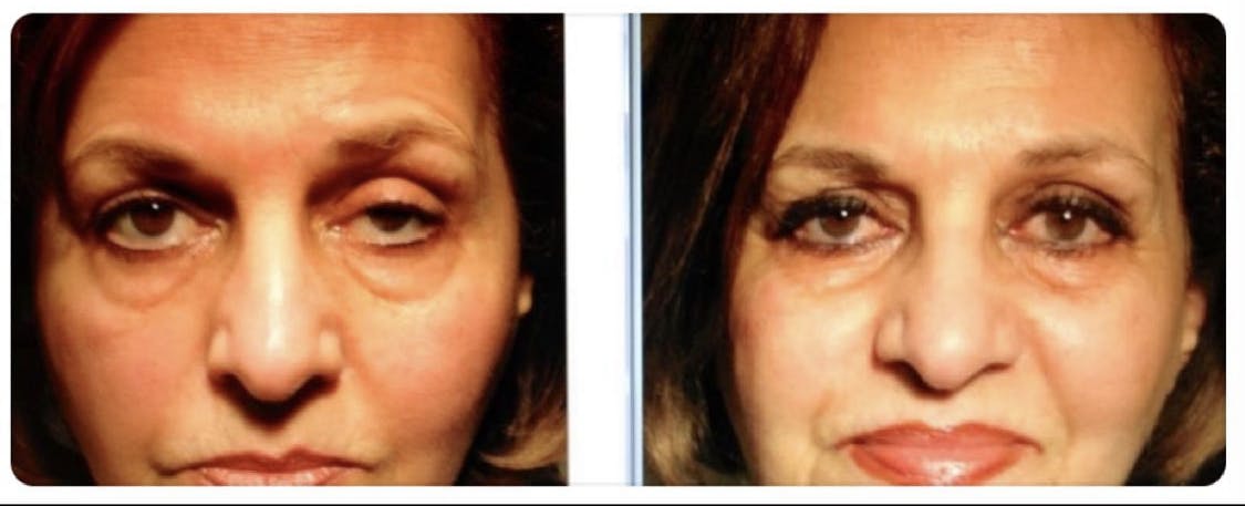 Droopy Eyelid Lift (