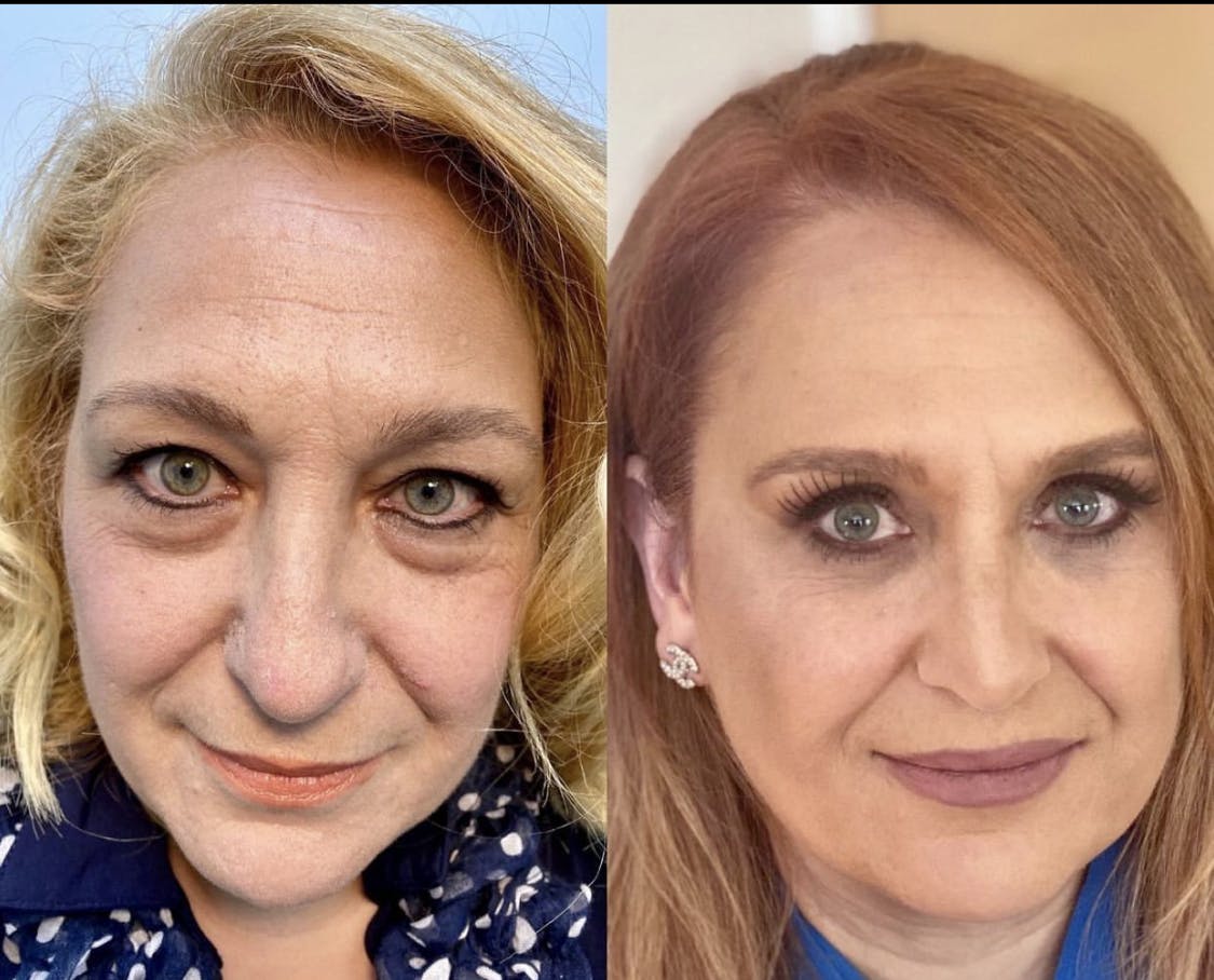 Blepharoplasty (Eyelid Surgery) Before & After Gallery - Patient 55495893 - Image 1