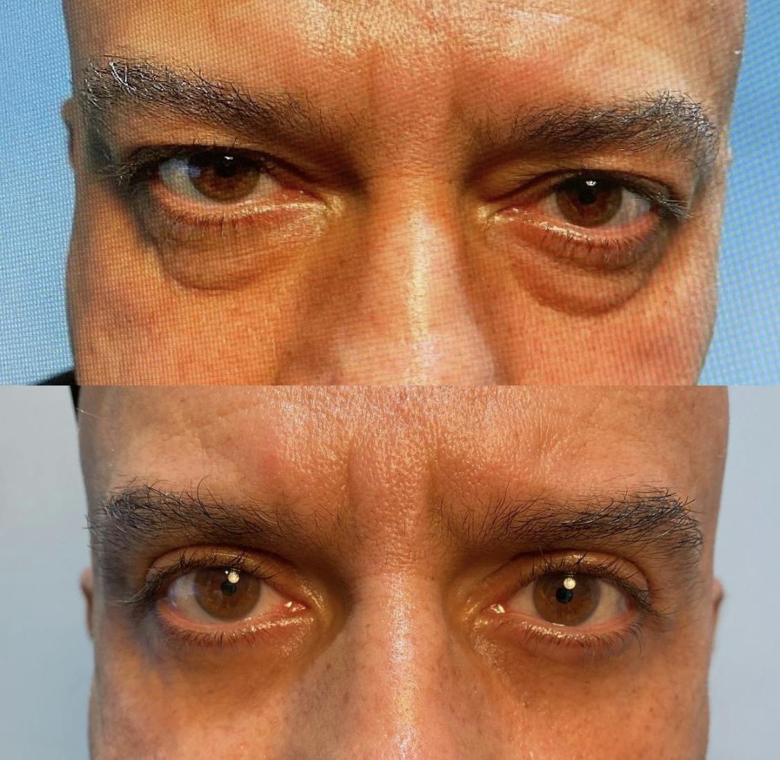 Blepharoplasty (Eyelid Surgery) Before & After Gallery - Patient 55495894 - Image 1