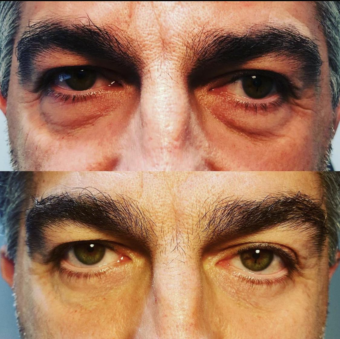 Blepharoplasty (Eyelid Surgery) Before & After Gallery - Patient 55495862 - Image 1