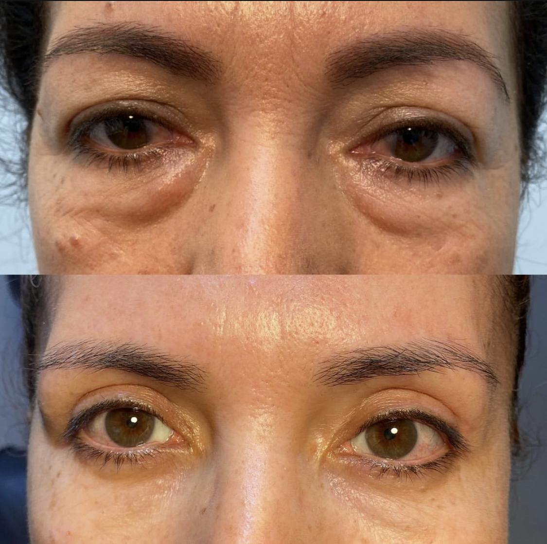 Blepharoplasty (Eyelid Surgery) Before & After Gallery - Patient 55495895 - Image 1