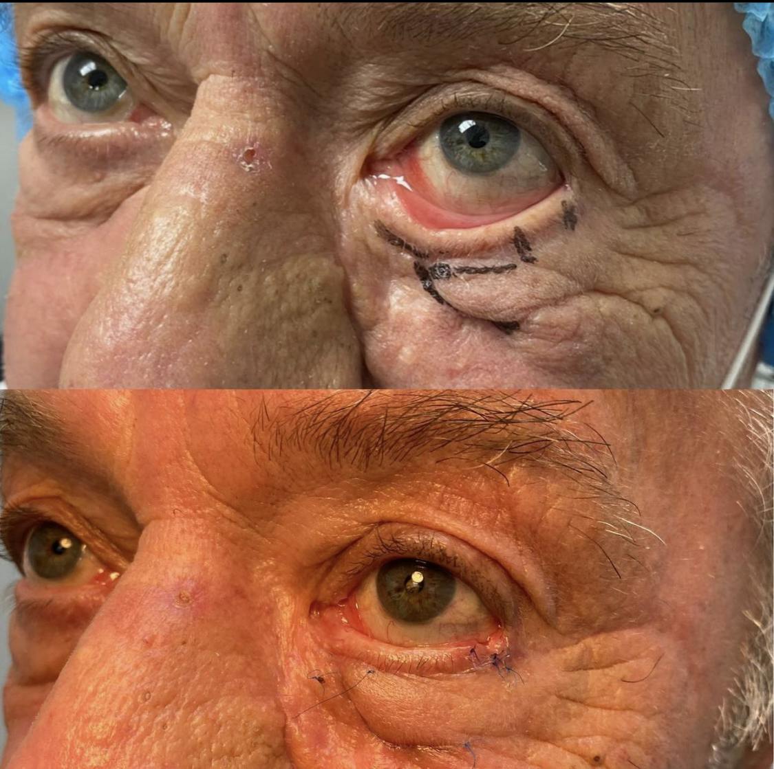 Ectropion (Everted Eyelid) Correction Before & After Gallery - Patient 53705075 - Image 1