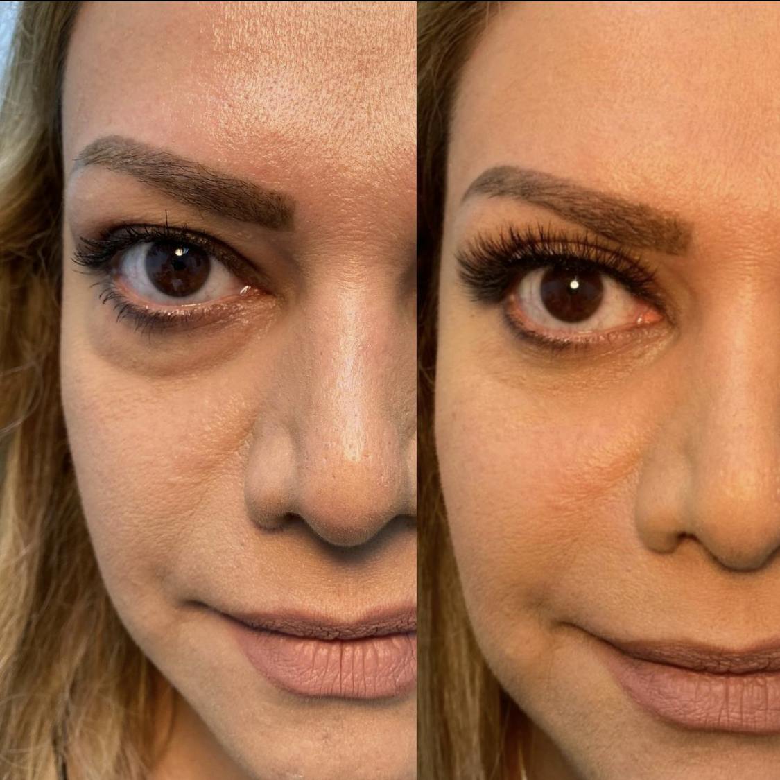 Blepharoplasty (Eyelid Surgery) Before & After Gallery - Patient 55495863 - Image 1