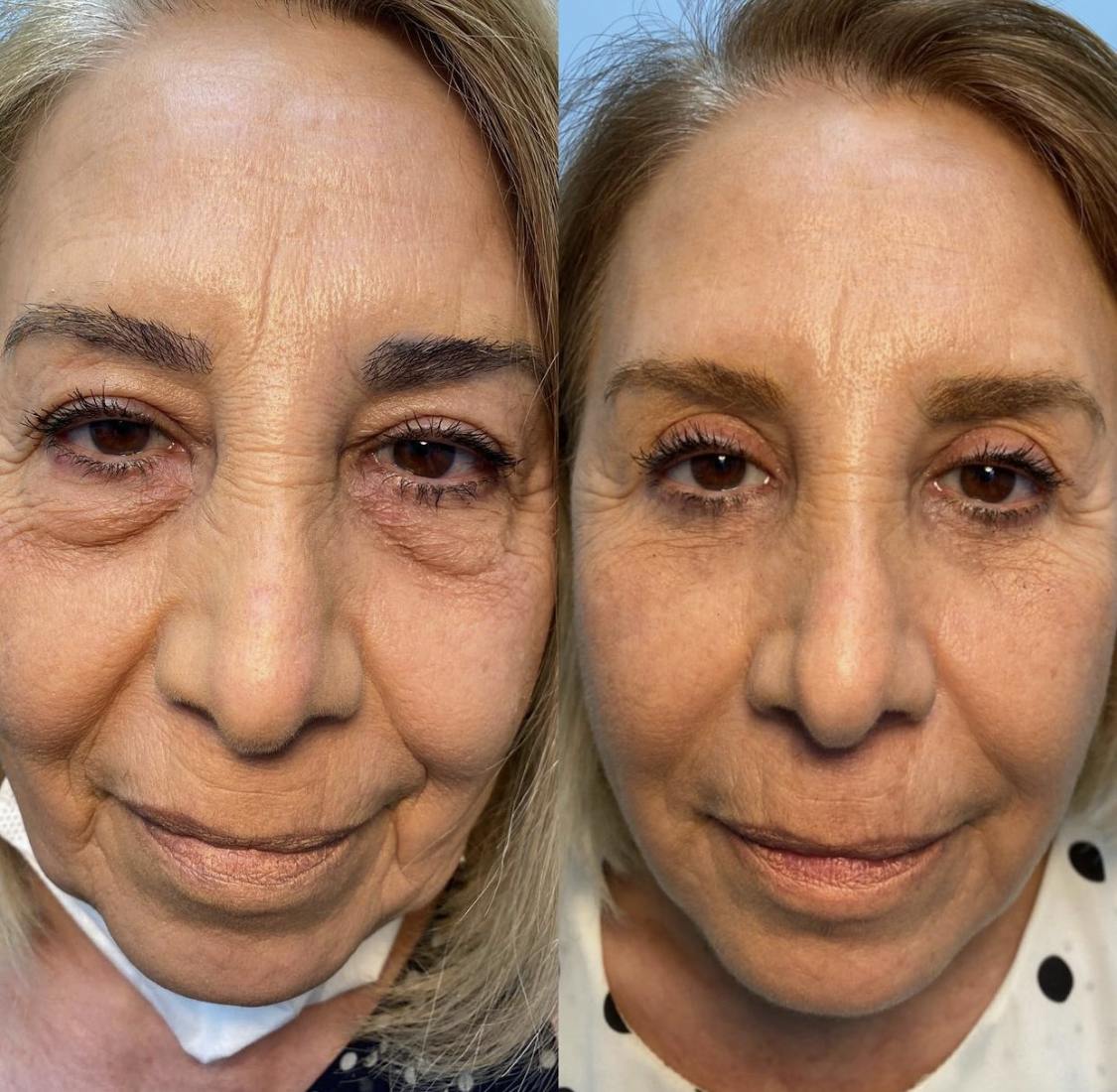 Blepharoplasty (Eyelid Surgery) Before & After Gallery - Patient 55495896 - Image 1