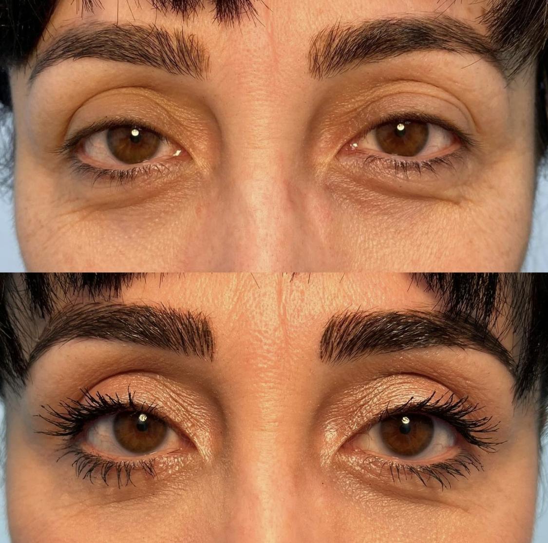 Droopy Eyelid Lift (