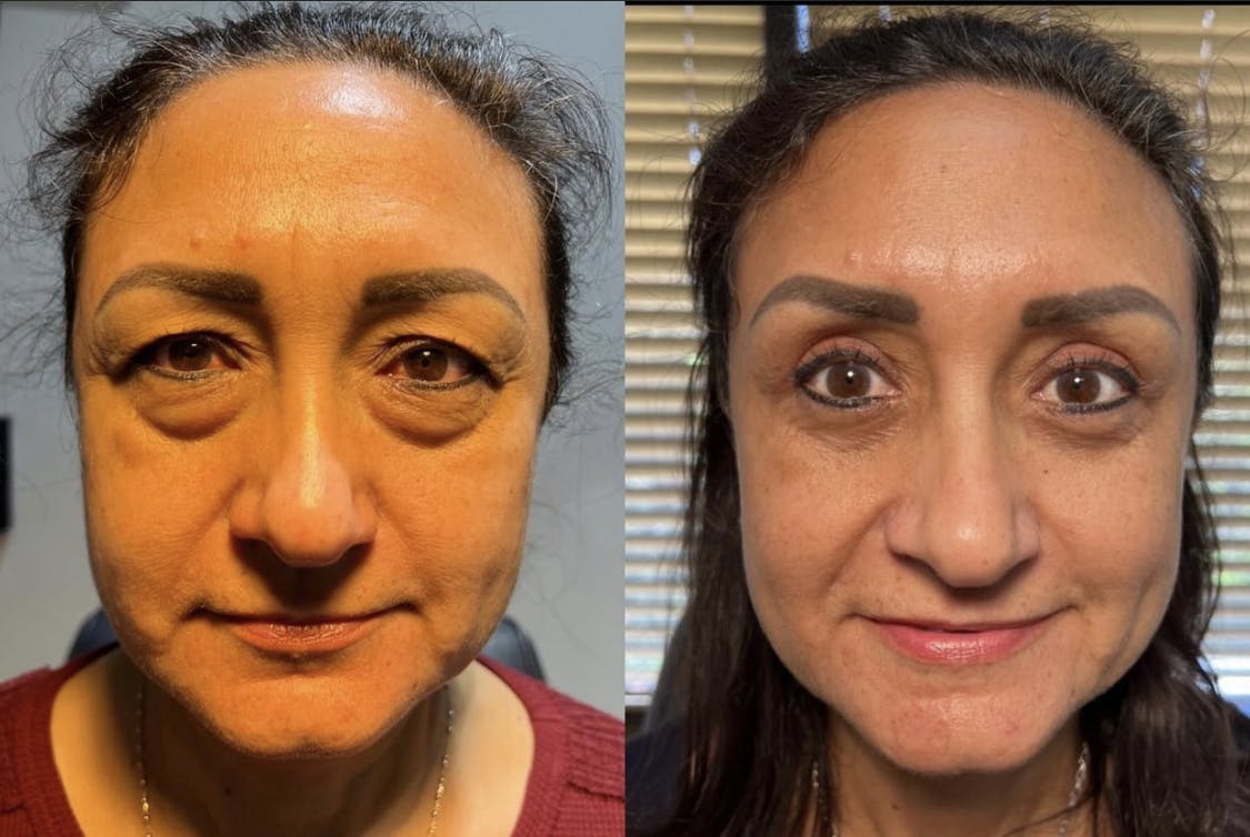 Blepharoplasty (Eyelid Surgery) Before & After Gallery - Patient 55495897 - Image 1