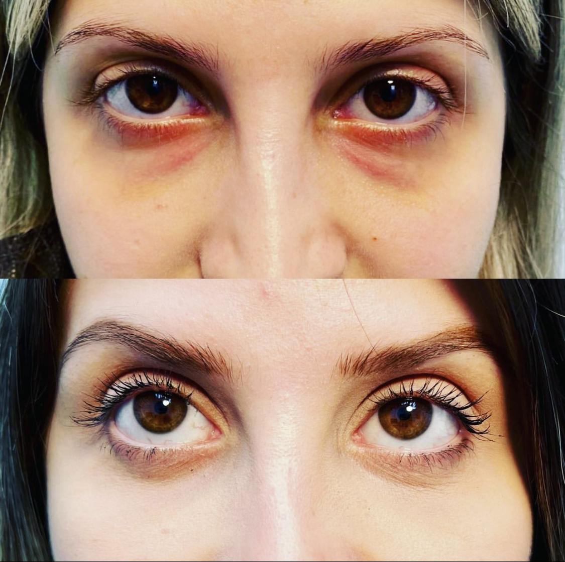 Blepharoplasty (Eyelid Surgery) Before & After Gallery - Patient 55495864 - Image 1