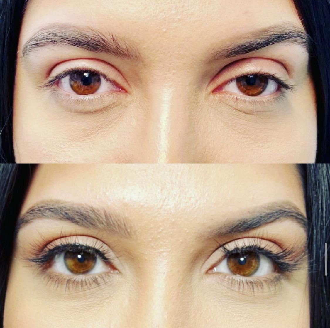 Droopy Eyelid Lift (