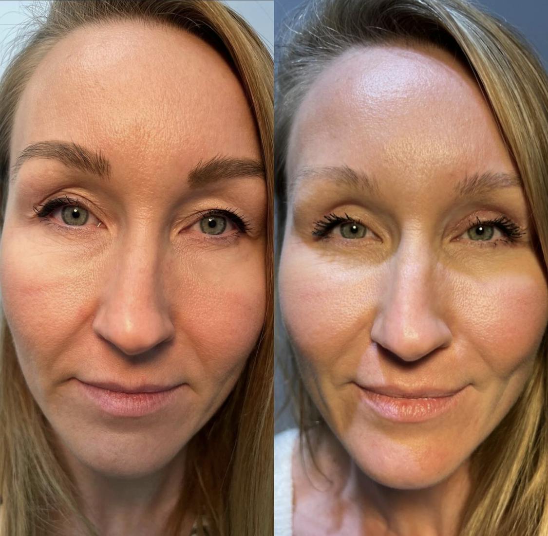 Blepharoplasty (Eyelid Surgery) Before & After Gallery - Patient 55495855 - Image 1