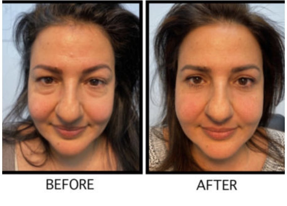 Blepharoplasty (Eyelid Surgery) Before & After Gallery - Patient 55495898 - Image 1