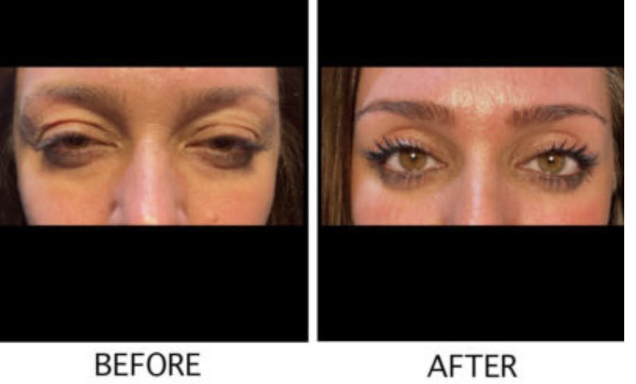 Droopy Eyelid Lift (