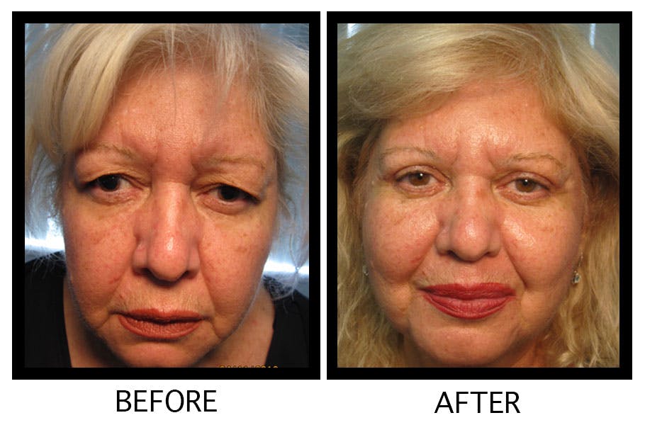 Blepharoplasty (Eyelid Surgery) Before & After Gallery - Patient 55495906 - Image 1