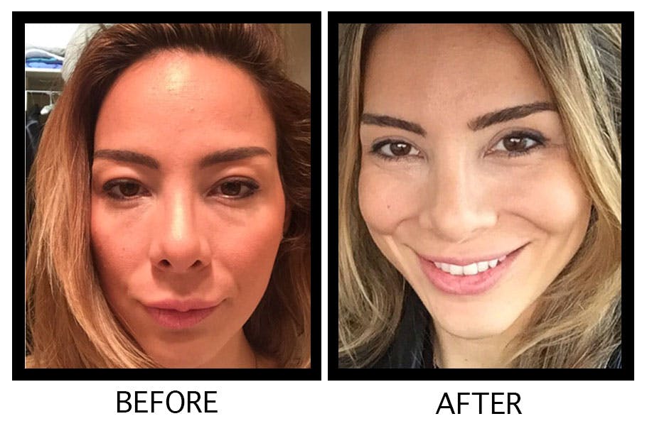 Blepharoplasty (Eyelid Surgery) Before & After Gallery - Patient 55495907 - Image 1