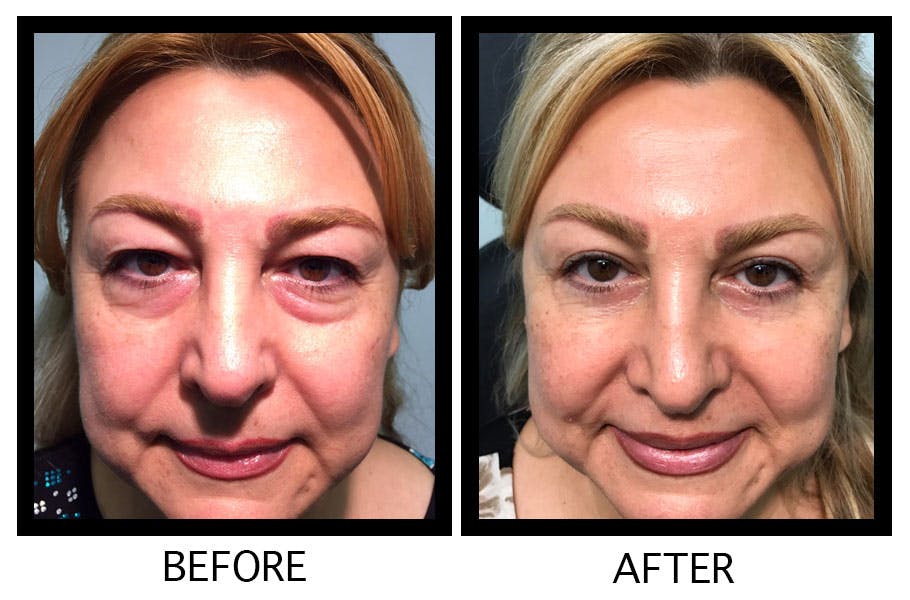 Blepharoplasty (Eyelid Surgery) Before & After Gallery - Patient 55495908 - Image 1