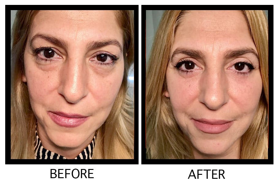Blepharoplasty (Eyelid Surgery) Before & After Gallery - Patient 55495909 - Image 1