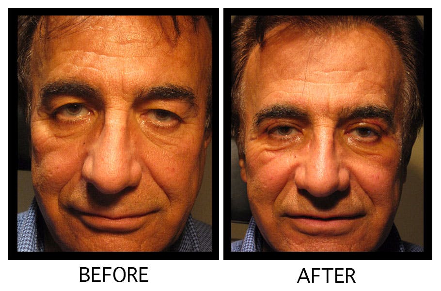 Blepharoplasty (Eyelid Surgery) Before & After Gallery - Patient 55495913 - Image 1