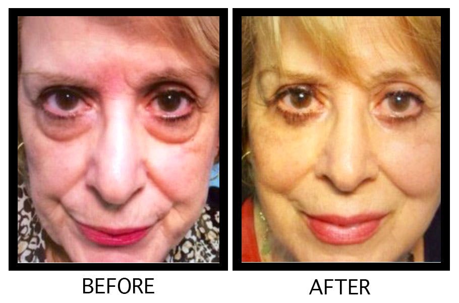 Blepharoplasty (Eyelid Surgery) Before & After Gallery - Patient 55495915 - Image 1