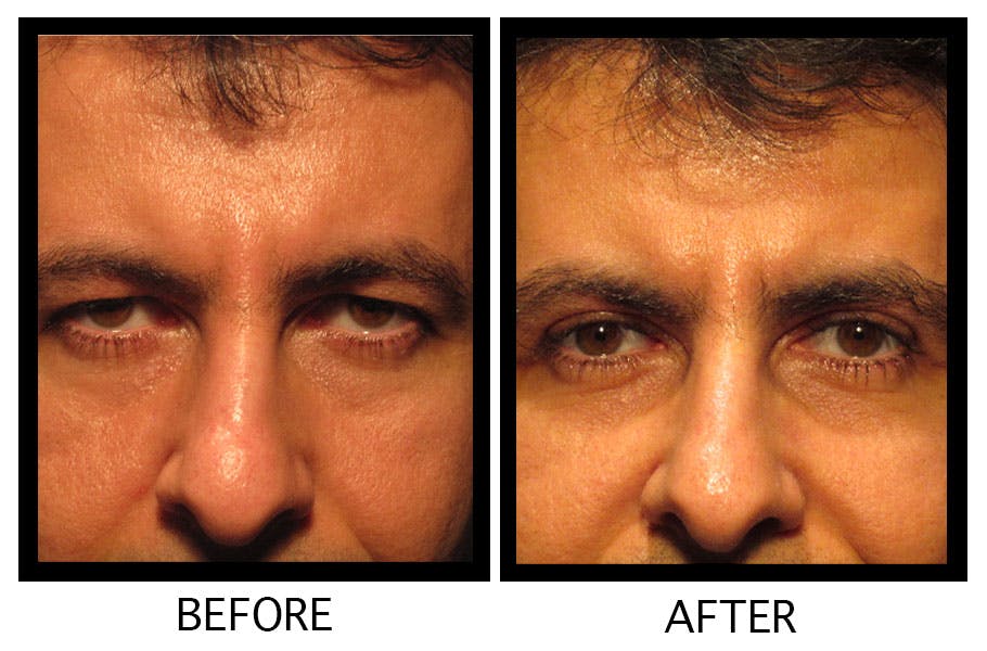 Blepharoplasty (Eyelid Surgery) Before & After Gallery - Patient 55495916 - Image 1