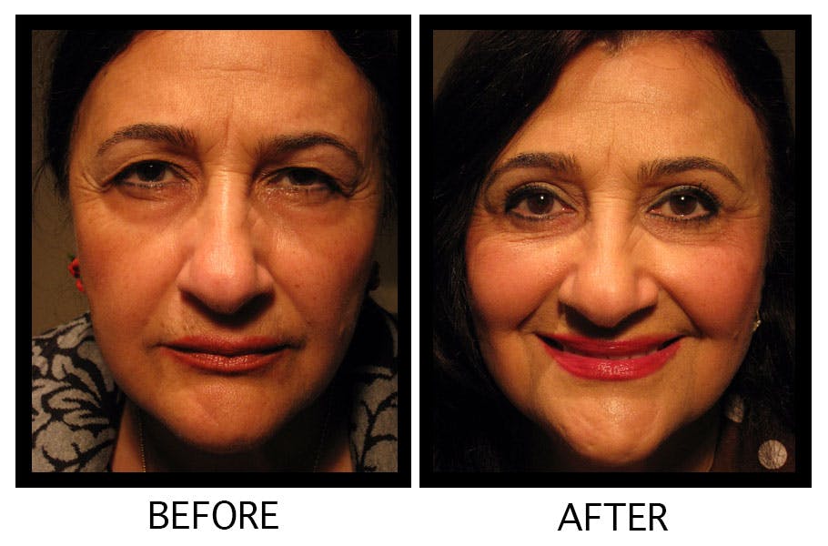 Blepharoplasty (Eyelid Surgery) Before & After Gallery - Patient 55495917 - Image 1
