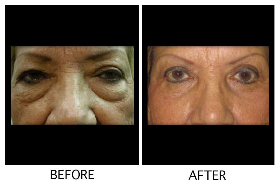 Blepharoplasty (Eyelid Surgery) Before & After Gallery - Patient 55495918 - Image 1