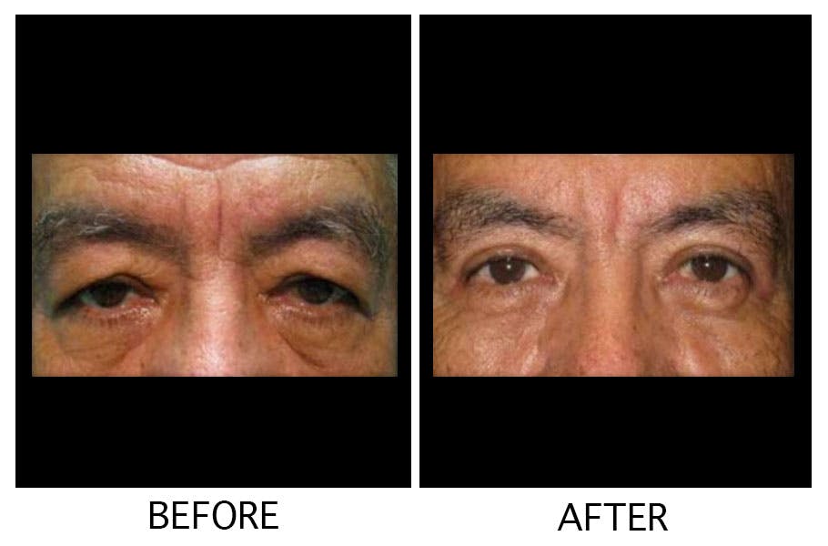 Blepharoplasty (Eyelid Surgery) Gallery - Patient 55495920 - Image 1