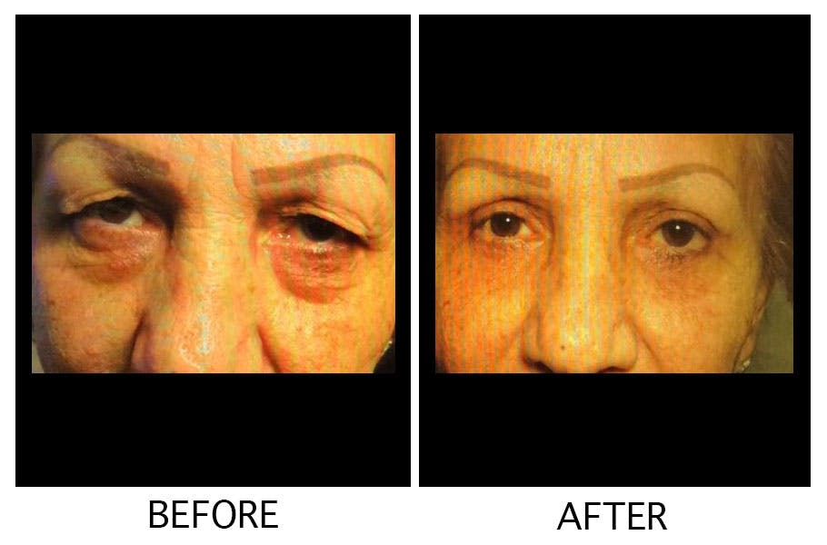 Blepharoplasty (Eyelid Surgery) Before & After Gallery - Patient 55495921 - Image 1