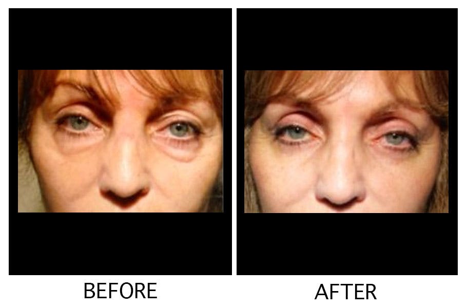 Blepharoplasty (Eyelid Surgery) Before & After Gallery - Patient 55495922 - Image 1
