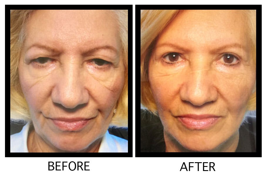 Blepharoplasty (Eyelid Surgery) Before & After Gallery - Patient 55495923 - Image 1