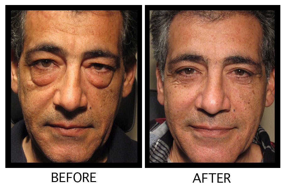 Blepharoplasty (Eyelid Surgery) Before & After Gallery - Patient 55495882 - Image 1