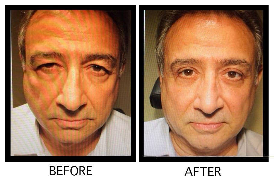 Blepharoplasty (Eyelid Surgery) Before & After Gallery - Patient 55495901 - Image 1