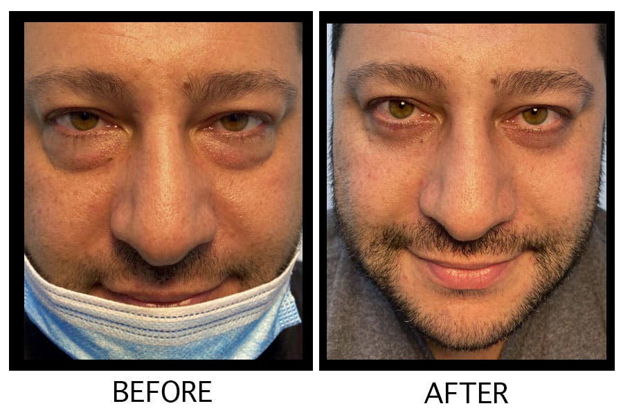 Blepharoplasty (Eyelid Surgery) Before & After Gallery - Patient 55495934 - Image 1