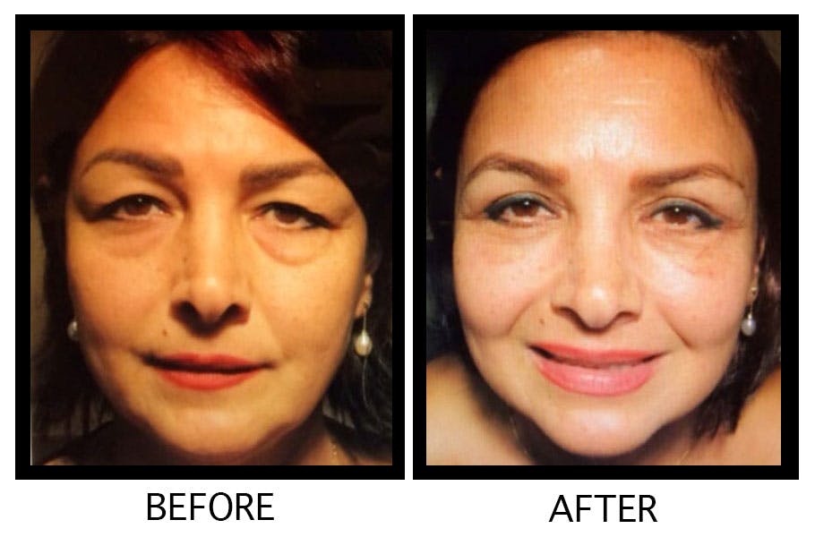 Blepharoplasty (Eyelid Surgery) Before & After Gallery - Patient 55495902 - Image 1