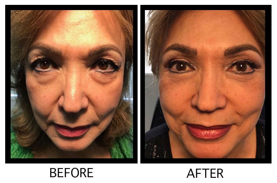 Blepharoplasty (Eyelid Surgery) Before & After Gallery - Patient 55495939 - Image 1