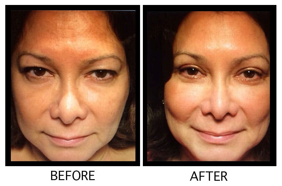 Blepharoplasty (Eyelid Surgery) Before & After Gallery - Patient 55495940 - Image 1