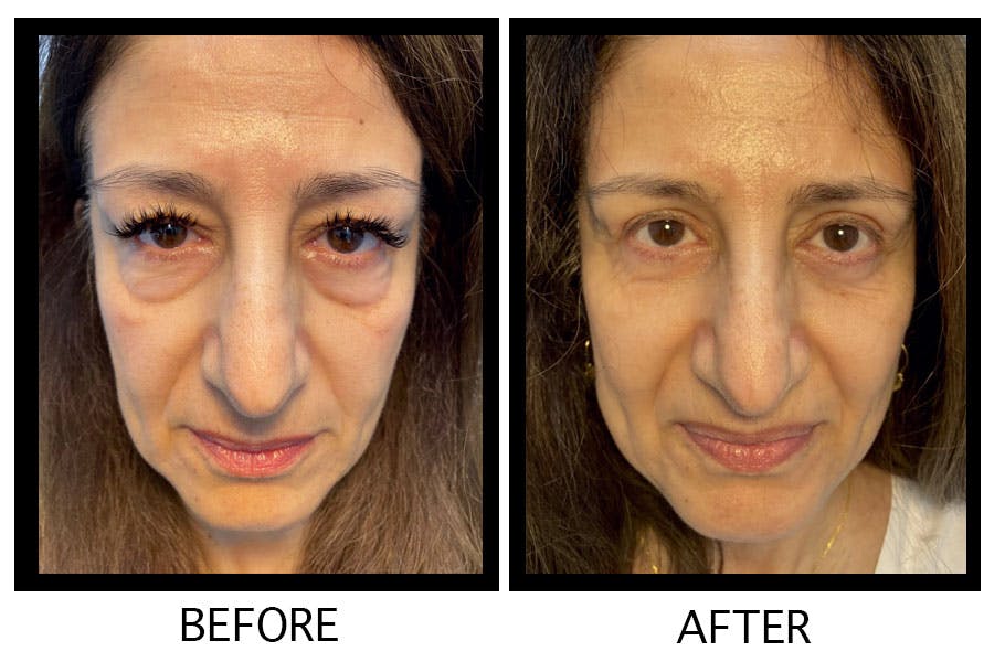 Blepharoplasty (Eyelid Surgery) Before & After Gallery - Patient 55495942 - Image 1
