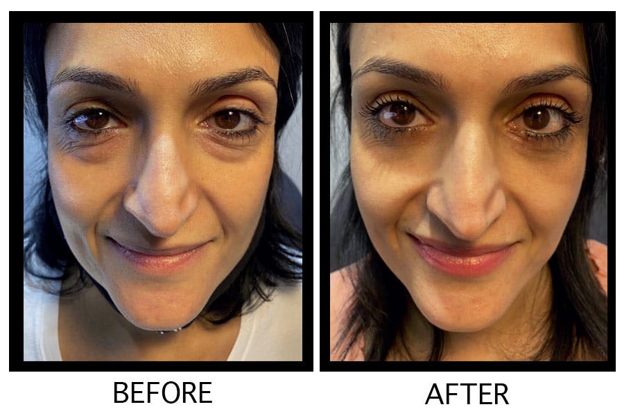 Blepharoplasty (Eyelid Surgery) Before & After Gallery - Patient 55495943 - Image 1