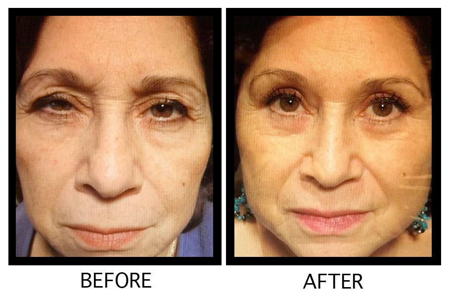 Blepharoplasty (Eyelid Surgery) Before & After Gallery - Patient 55495948 - Image 1