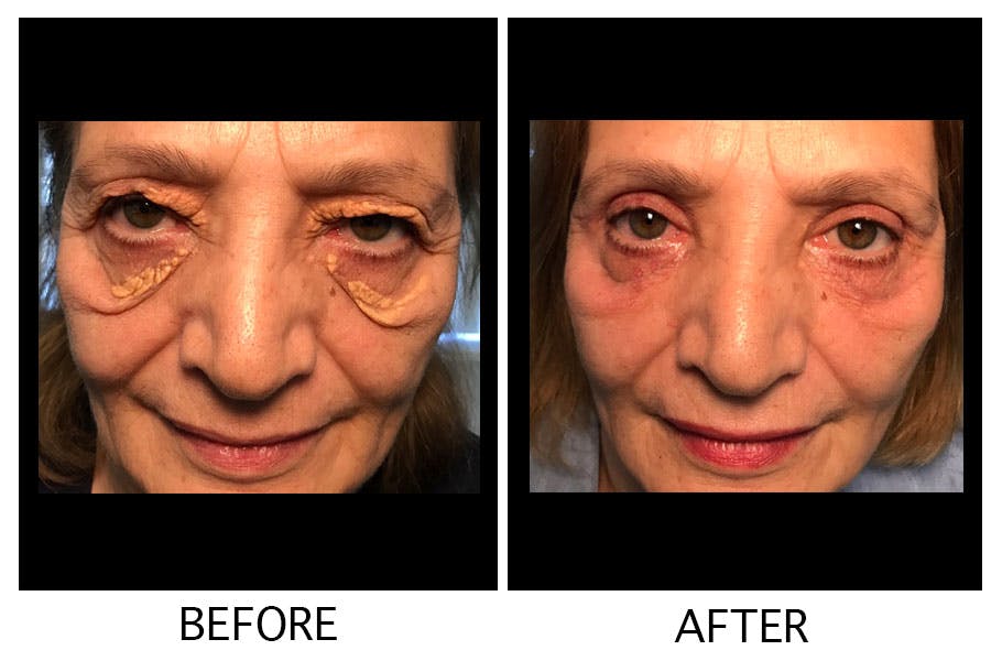 Blepharoplasty (Eyelid Surgery) Before & After Gallery - Patient 55495949 - Image 1