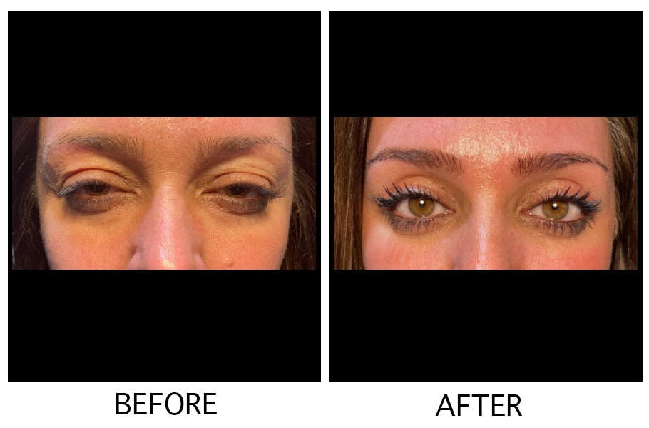 Blepharoplasty (Eyelid Surgery) Before & After Gallery - Patient 55495950 - Image 1