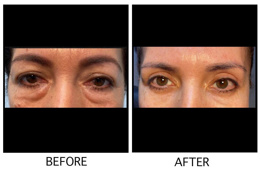 Blepharoplasty (Eyelid Surgery) Before & After Gallery - Patient 55495951 - Image 1