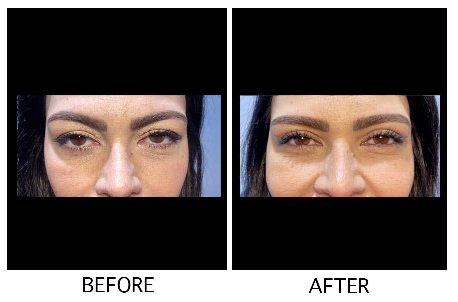 Blepharoplasty (Eyelid Surgery) Before & After Gallery - Patient 55495952 - Image 1