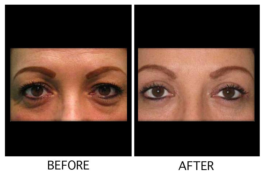 Blepharoplasty (Eyelid Surgery) Before & After Gallery - Patient 55495953 - Image 1